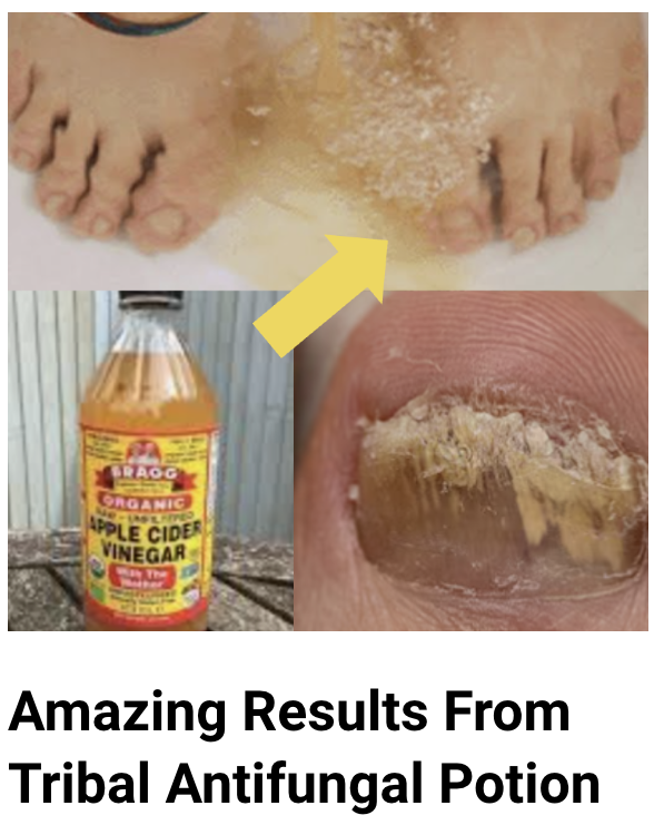 types of toenail fungus